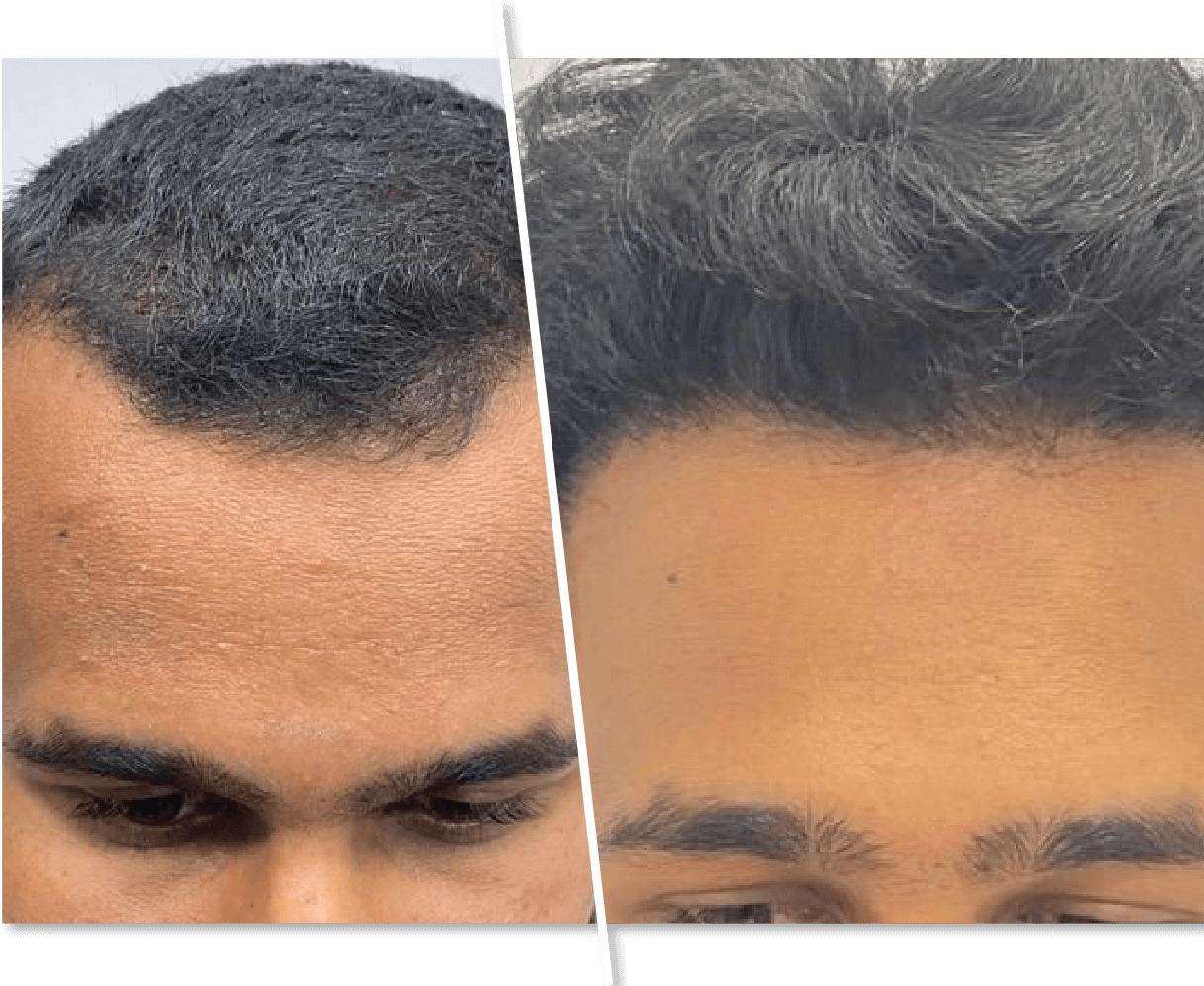 Men Hair regrowth Before and After